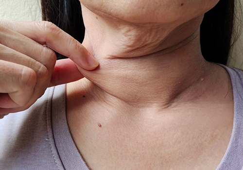 Flacidez facial y corporal