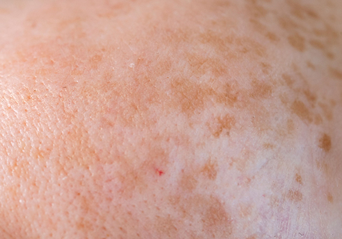 Manchas y melasma